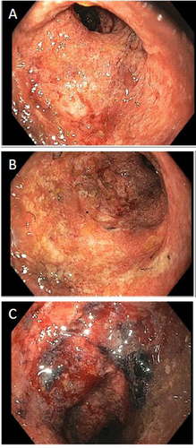 Figure 6 Flexible sigmoidoscopy demonstrating Mayo endoscopic subscore 3 (A–C).