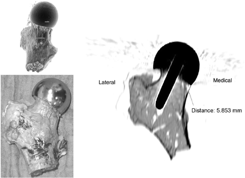 Figure 6. Notched probe: Femoral neck notching on the medial portion.