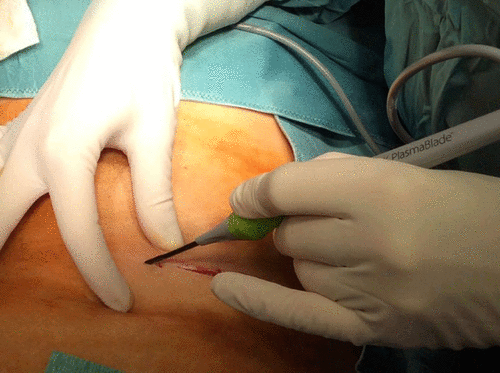 Figure 1. Initial incision in the skin with the PlasmaBlade.