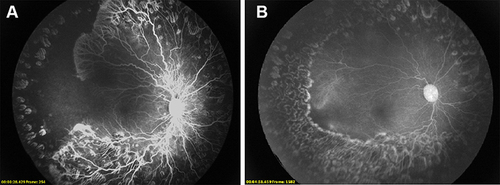 Figure 1 (A) Right eye of an infant who was injected ranibizumab and subsequently lasered. The inadequate laser resulted in persisted aggressive ROP. (B) Three-week follow-up angiography of the same infant who underwent fill-in laser which was performed to address all residual avascular and ischemic regions.