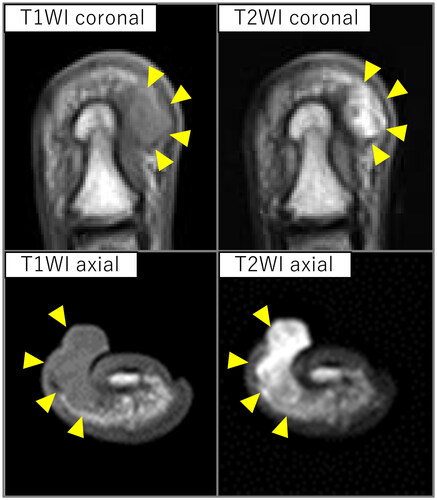 Figure 3. Magnetic resonance imaging findings. An iso-intensity in T1 and high-intensity in T2 weighted images lesion was observed protruding subcutaneously to the body surface on the ulnar aspect of the distal phalanx (arrowhead).