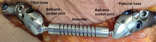 Figure 2 KineSpring system implanted on a cadaver knee (superficial layers have been resected (femoral and tibial incisions extended to meet each other above the absorber) for measurement access and visualization). Shown are a tibial base (on the left-hand side of the image), an absorber (including sockets and spring), and a femoral base (on the right-hand side of the image). Also shown are some of the locking screws (blue) and cancellous screws (silver) used to fix the bases in place.