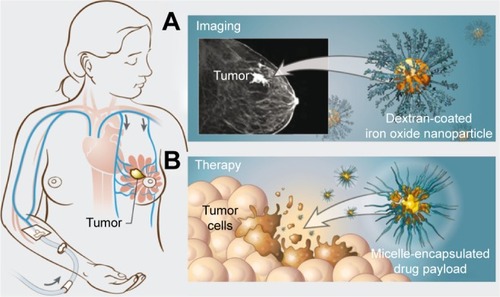 Figure 2 Nanoparticles in cancer management.Notes: Nanoparticle accumulation at the tumor site can be used to deliver (A) contrast agents such as dextran-coated iron oxide nanoparticles for magnetic resonance imaging (MRI) or (B) chemotherapeutic drugs encapsulated in nanomaterials such as micelles. Reproduced with permission of Annual Review of, Volume 14 © by Annual Reviews, http://www.annualreviews.org. Albanese A, Tang PS, Chan WCW. The effect of nanoparticle size, shape, and surface chemistry on biological systems. In: Yarmush ML, editor. Palo Alto, CA: Annual Review of Biomedical Engineering. Vol 14. 2012:1–16.Citation3