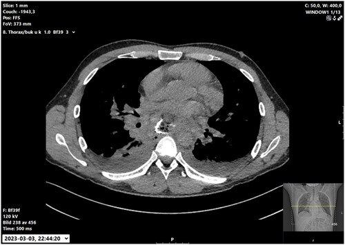 Figure 1. CT-scan three days after mediastinoscopy confirms an esophageal perforation with contrast leakage.