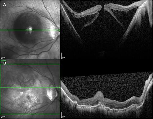 Figure 5 Pre- and postoperative OCT image of a 61-year-old woman (case 4). (A) Preoperative OCT shows a high myopic eye with MHRD and PS. (B) 24 months postoperative OCT shows flattening of the posterior sclera with MH closure and retinal reattachment.