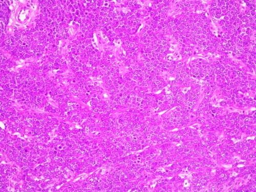 Figure 2.  Biopsy specimen of the involved skin with a plasma cell infiltrate. HE staining.