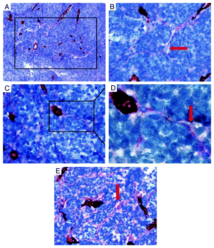Figure 3. The presence of VM in medulloblastoma was associated with shorter survival time by Kaplan-Meier survival analysis and log-rank test (VM-positive 9, censored 2 vs. VM-negetive 32, censored 18).