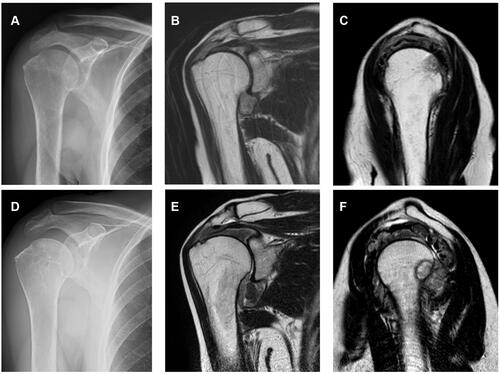 Figure 1 X-ray and magnetic resonance imaging (MRI) of the right shoulder in Patient 1. At the first visit, X-ray showed no bone erosion (A) and T2-weighted MRI showed synovial proliferation in the glenohumeral joint and rotator cuff tears (B). There were only slight bone signals in the humeral head (C). Nine months later, X-ray showed bone erosions in the humeral head (D) and MRI showed much more remarkable synovial proliferation and numerous bone erosions in the humeral head (E and F).