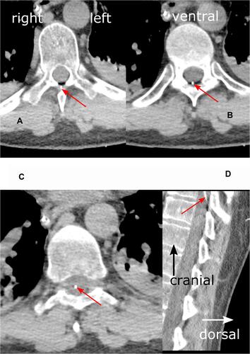 Figure 2 Detail enlargements of axial (A–C) and sagittal (D) thoracic CT scans in a soft tissue window at level Th9. Red arrows indicate epidural catheter (white dot). (A) (left upper panel): The catheter is shown passing the ligamentum flavum ventral to the spinous process. (B) (right upper panel): Imaging of the catheter in the epidural space. (C) (left lower panel): Catheter position almost in the middle of the dural sac, suggesting a position inside the spinal cord. (D) (right lower panel): Entry of the epidural catheter into the dural sac. The terminal 4 centimeters of the catheter are not shown. Additional findings: consolidations (atelectasis) of the posterior lower lobes, nasogastric tube.
