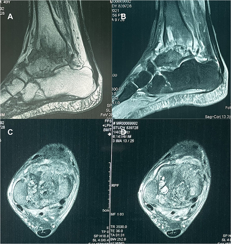 Figure 3 MRI examination of the patient on admission. (A and B) Sagittal T1T2-weighted image shows an abnormal signal, a narrowing of the right ankle joint, and coarse articular surfaces. (C and D) Axial image shows erosion and destruction of the medial and medial malleolus of the talus, with multiple cystic changes.