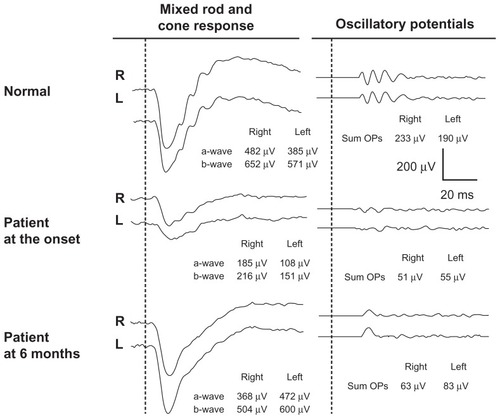 Figure 3 Changes in full-field electroretinograms.