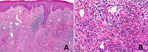 Figure 2 Histopathology: (A) mild epidermal spongy edema with parakeratosis (hematoxylin-eosin, x100). (B) Extensive infiltration of inflammatory cells in the dermis, including eosinophils, neutrophils, and lymphocytes. The superficial capillaries in the dermis dilated, and the blood vessel walls ssuppl welled (hematoxylin-eosin, x400).