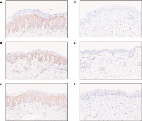 Figure 7 The expression of IRF7 in psoriatic skin lesions before and after guselkumab treatment. (A–C) The expression of IRF7 in psoriatic skin lesions before guselkumab treatment. (D–F) The expression of IRF7 in psoriatic skin lesions after 12 weeks of guselkumab treatment.