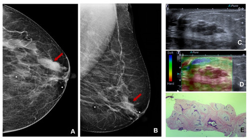 Figure 8 Left mammogram SDD (red arrow) at cranio-caudal (CC) (A) and medio-lateral oblique (MLO) (B) mammogram view. Targeted US shows intraductal mass (C) and high elastography (D); H&E staining (x10) shows fibroadenoma (E).