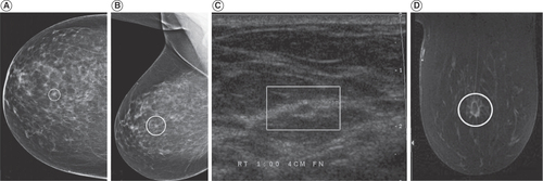 Figure 2. Imaging findings of invasive lobular carcinoma. (A) Craniocaudal and (B) mediolateral oblique views of the right breast demonstrate a spiculated lesion (ovals). (C) Ultrasound image demonstrates a hypoechoic lesion with echogenic rim. (D) Postcontrast MRI demonstrates rim-enhancement of the mass with extension of enhancement within adjacent tissue (oval).Adapted with permission from Dhillon et al. [Citation17].