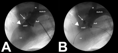 Figure 4. Fluoroscopic images obtained during TAVR device deployment. Figure 4A presents an angiogram collected prior to TAVR insertion. Note the modified aortic annulus (white arrow) with aortic insufficiency present (arrow head). Figure 4B presents a post-insertion angiogram with the TAVR device seated within the modified aortic annulus (white arrow). Note that aortic insufficiency is no longer present (arrow head) following TAVR insertion.