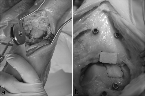 Figure 5. Human cadaver ankle joint after implantation of the tibial and talar graft.