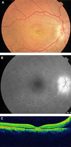 Figure 2 (A) Fundus photograph of the right eye of a patient with cat scratch disease showing optic disc edema and a complete macular star consistent with a diagnosis of neuroretinitis. (B) Late-phase fluorescein angiogram shows optic disc leakage with no abnormalities in the macular area. (C) Optical coherence tomography shows peripapillary serous retinal detachment.