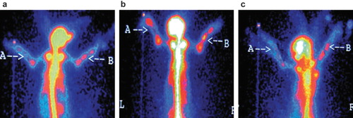 Figure 6. Radionuclide bone imaging photo of group B: (a) at 4th week; (b) at 8th week; (c) at 12th week, respectively.