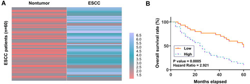 Figure 1 Poor prognosis of ESCC patients was correlated with the high expression level of CircRIMS in ESCC tissues. ESCC and paired non-tumor tissue samples were subjected to RNA isolation and RT-qPCR to determine the differential expression of CircRIMS in ESCC, which is expressed as a heatmap plotted using Heml 1.0 software (A). With the median expression level of CircRIMS in ESCC tissues as a cutoff value, the 64 ESCC patients were grouped into high and low (n=32) level groups (B).