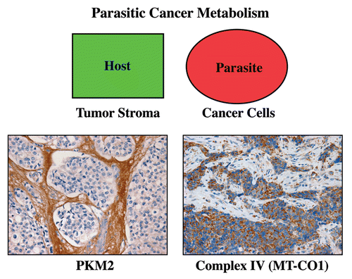 Figure 9 Metabolic compartments in parasitic cancer metabolism. In summary, we believe that cancer cells act as metabolic parasites and extract nutrients from host cells by inducing catabolic processes (autophagy, mitophagy, aerobic glycolysis and lipolysis). As a consequence, the tumor stroma shows a shift toward aerobic glycolysis, and epithelial cancer cells show functional hyper-activation of oxidative mitochondrial metabolism (OXPHOS). In support of this model, cancer-associated fibroblasts and the tumor stroma overexpress PKM2 (a rate-limiting glycolytic enzyme, left panel). Conversely, breast cancer epithelial cells upregulate MT-CO1 (a key component of mitochondrial complex IV, right panel). The metabolic compartmentalization of PKM2 and MT-CO1 were visualized by immunostaining with specific antibody probes (brown reaction product). Reproduced and modified with permission from references Citation14 and Citation80.