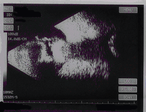 FIGURE 4  Ocular ultrasound - Posterior Granuloma.
