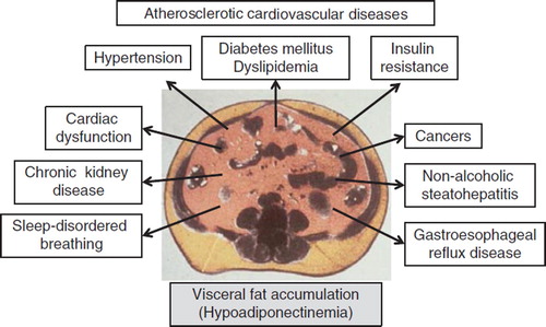 Figure 3. Visceral fat accumulation and hypoadiponectinemia are related to a variety of diseases (visceral fat centric theory).