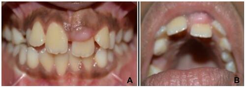 Figure 1 (A) Labial view of gingival enlargement in relation to maxillary left central incisor (21) (B) Gingival enlargement has displaced 21 palatally.