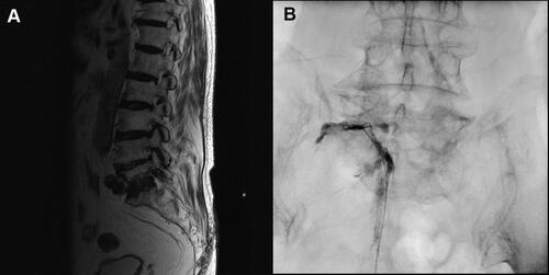 Figure 1 (A) T2-weighted sagittal magnetic resonance imaging showing left L5-S1 foraminal stenosis. (B) Left L5 selective nerve root injection using a Racz catheter.