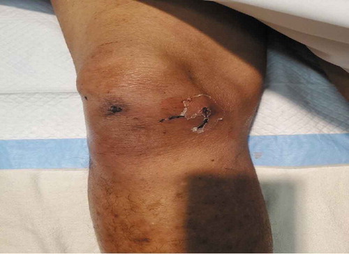 Figure 1. Right knee partially healed wound