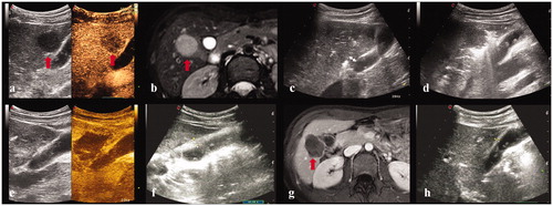 Figure 2. A 28-year-old female. (a, b) Contrast-enhanced ultrasound and MRI indicated a liver tumor located in segment 5 abutting the gallbladder with a maximum diameter of 27 mm. The thickness of gallbladder wall was 4 mm. (c) The electrode was inserted parallel to the gallbladder wall with a minimum distance of 8 mm. (d) The observation of gallbladder wall was affected by the gas produced by ablation. (e) Contrast-enhanced ultrasound showed that the perfusion of gallbladder wall was intact and the index tumor had been completely ablated. (f) Three day after ablation, the thickness of gallbladder wall increased to 9 mm. (g) Contrast-enhanced MRI one month after the ablation procedure confirmed the complete ablation of the index tumor. (h) Four months after ablation, the thickness of gallbladder wall was restored to 4 mm.