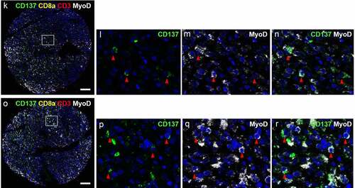 Figure 2. CD137 expression on T cells (white arrowheads) and RMS cells (red arrowheads). (a-j) Images from cores of a patient (56/M) with ERMS. A is the image from core G5. B-E are magnified images of the area highlighted in A. F is the image from core G6. White arrowheads indicate colocalization of CD3 and CD8. G-J are magnified images of the area highlighted in F. (k-r) Images from cores of a patient (50/F) with PRMS. K is the image from core F3. L-N are magnified images of the area highlighted in K. O is the image from core F4. P-R are magnified images of the area highlighted in O. Red arrowheads indicate colocalization of CD137 and MyoD. Scale bar = 400 μm