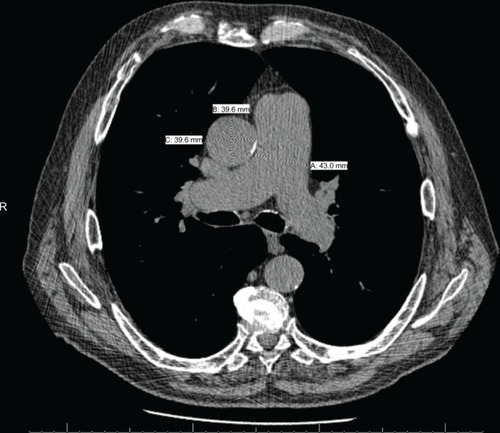 Figure 2 Measurement of the pulmonary artery (PA) and ascending aorta (A) diameters at the level of the PA bifurcation. PA diameter = line (A) (43.0 mm) and A diameter = average of lines (B) + (C) (39.6 mm) result in a PA:A ratio >1.