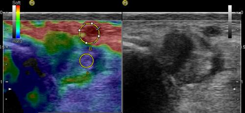 Figure 7 Sonoelastogram (left side of the images) and corresponding B-mode ultrasound images (right side of the images) of the PL tendon. In this ROI, transversal sections were acquired in all patients.