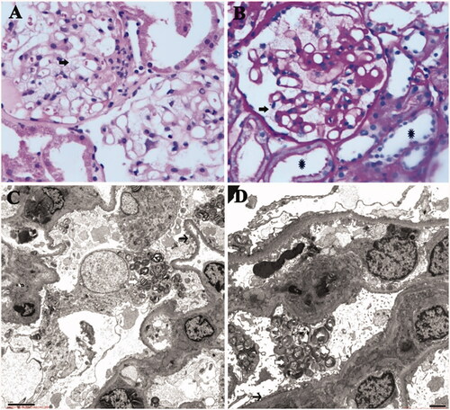 Figure 3. (A) (HE 400×) and (B) (PAS 400×): Light microscopy showed normal glomerular volume, well-opened capillary loops, and mild segmental mesangial widening with increasing mesangial matrix. Swollen podocytes with abundant, foamy, clear cytoplasm were observed (arrow); mild chronic tubulointerstitial lesions and mild acute lesions were presented, along with flattened tubular epithelial cell and brush border loss (asterisk). (C and D) By electron microscopy, glomerular capillary loops were well-opened and basement membranes were of normal thickness. Extensive foot process fusion (black arrow) with microvillus transformation was observed in the podocyte. And osmiophilic lamellar inclusions were abundantly presented in the podocyte cytoplasm, some of which showed appearance of zebra body (white arrow).