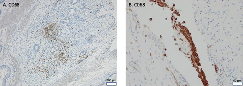 Figure 3. CD68 immunohistochemical staining. A, Clustered CD68 positive cells in mature area of immature teratoma (Patient 4). Scale bar 200 µm. B, Typical clustering of CD68 positive cells in clefts between neuroglial cells, 10x low power field, scale bar 60 µm.