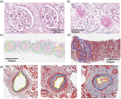Fig. 2.  Example of biopsies morphometric observation indices of nephron hypertrophy and nephrosclerosis/glomerulosclerosis. (a) Two functional non-sclerotic glomeruli; (b) 2 globally sclerosed glomeruli; (c) 5 consecutive 0.2 mm2 circles (green) in which full (red) or partial (cyan) tubules are labelled, and their area subsequently quantified after exclusion of all non-tubular structures (yellow); (d) area of cortical fibrosis and tubular atrophy outlined in blue dashed line; (e) the percent intimal thickening (arteriosclerosis) was determined by the area of intima (between yellow and blue boundaries) divided by the area of intima and lumen (within blue boundary). Examples of different degrees of intimal thickening are shown in E1–no thickening, E2–moderate thickening and E3–severe thickening.