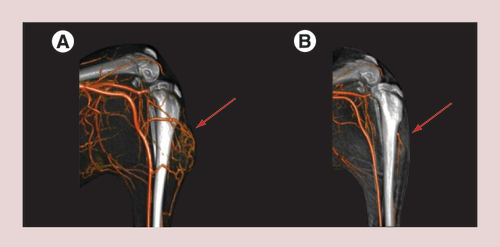 Figure 7. Angiographic image of the left hind limb of a rabbit with a VX2 tumor before and after magnetic drug targeting.Imaging was done (A) directly before magnetic drug targeting and (B) 11 weeks later. It can be seen that 11 weeks after one single treatment with 10% of a regular systemic dose, the tumor had disappeared completely and no adverse side-effects occurred. Red arrow: tumor area.