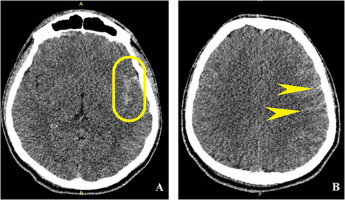 Figure 7 Axial NECT of 16-year-old male pedestrian hit by a slow-moving car. Left temporo-parietal traumatic subarachnoid haemorrhage. (A) Axial NECT brain window shows left Sylvian fissure occupied by hyperdense linear material (clotted blood) – yellow capsule. (B) Axial NECT brain window shows hyperdense fine lines between left parietal gyri (clotted blood) – yellow pointed arrows.