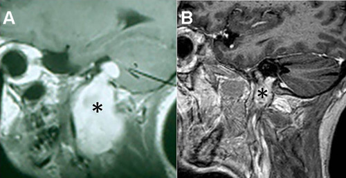 Figure 4 Lower cranial nerve schwannomas with intra- and extracranial extension. (A) T1-weighted MRI with contrast of a Type D vagal schwannoma (*). (B) T1-weighted MRI with contrast of a Type B hypoglossal schwannoma (*).