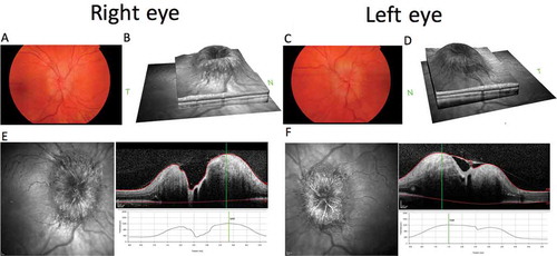 Figure 2. Composite figure showing colour fundus photographs of the papilloedema affecting the optic nerve head (OHN) of the right (A) and left (C) eyes. Optical coherence tomography (OCT) SPECTRALIS HRA+OCT (Heidelberg Engineering, Heidelberg, Germany), infrared (IR) images of the ONH, and volume cross-sectional images and the elevated height through the centre of the ONH of the right (E) and left (F) eyes. OCT IR disc volume reconstructions for right (B) and left (D) eyes.