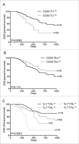 Figure 2. B cell spatial organization impacts in human PDAC prognosis. (A–C) Distinct spatial localization of B cells in the tumor microenvironment dictates their prognostic behavior. Kaplan–Meier survival analyses show correlation of high density of CD20-TLT (2nd–4th quartiles) with longer disease specific survival (p = 0.0085; n = 104) (A), while high density of CD20-TILs (3rd–4th quartiles) shows a tendency to associate to worse prognosis (p = 0.115; n = 104) (B). The immune signature comprising CD20- TLThi /CD20- TILlo robustly predicts longer survival (p = 0.0051; n = 104) (C). p value by Wilcoxon–Mantle Cox test.