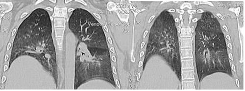 Figure 3 Selected chest CT images show interval resolution of bilateral consolidation.