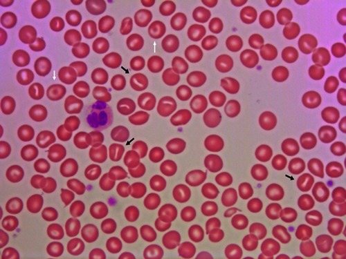 Figure 1 Peripheral blood smear from a patient with dehydrated stomatocytosis. The smear reveals stomatocytes (black arrows) and target cells (white arrows).