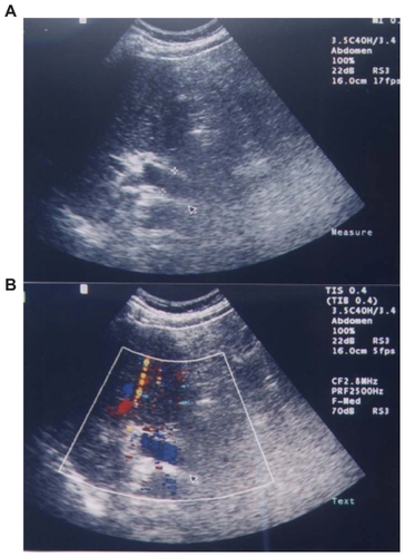 Figure 2 Abdominal doppler echosonography shows signs of portal hypertension, previous portal vein thrombosis, and revascularization of the portal vein.