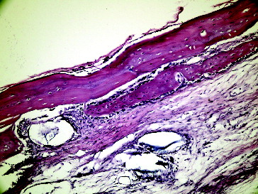 Figure 5. Fourteenth day grafted defect with LPT in Group I.