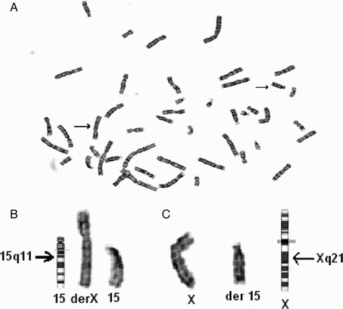 Figure 1.  Cytogenetic analysis using G-banding assay from cultured peripheral blood lymphocytes. A) Metaphase image of the patient; upper arrow: der(15) chromosome and lower arrow: der(X) chromosome; B) Chromosome 15 ideogram, der(X)(Xpter → Xq21::15q11 → 15qter) chromosome, chromosome 15, and C) Chromosome 15, der (15)(15pter → 15q11::Xq21 → Xqter) chromosome, and X chromosome ideogram.