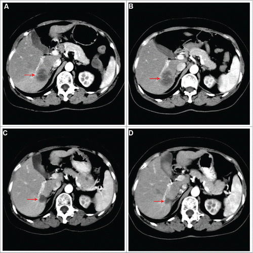 Figure 4. Abdominal CT scans showing dynamic changes of liver metastatic lesions during multi-line treatments. (A) Progression to regimen of trastuzumab combined with docetaxel as first-line maintenance treatment. (B) Progression to regimen of trastuzumab combined with carboplatin as second-line treatment. (C) After third-line treatment with lapatinib plus paclitaxel regimen. (D) On third-line treatment with trastuzumab plus paclitaxel.