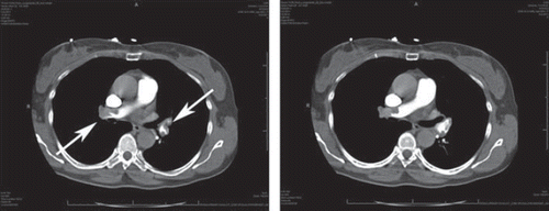 Figure 5. Contrast-enhanced CT scans of the chest showing adjacent slices with bilateral thrombi (arrows).