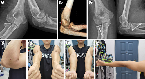 Figure 5 Male, 23 years with fracture type II who underwent ORIF by novel approach: (A and B): X-ray and 3D-CT images after injury showing a Mason type II fracture; (C): X-ray at 6 months postoperation showing healing of the fracture; (D-G): The ROM of shoulder at 6 months postoperation.